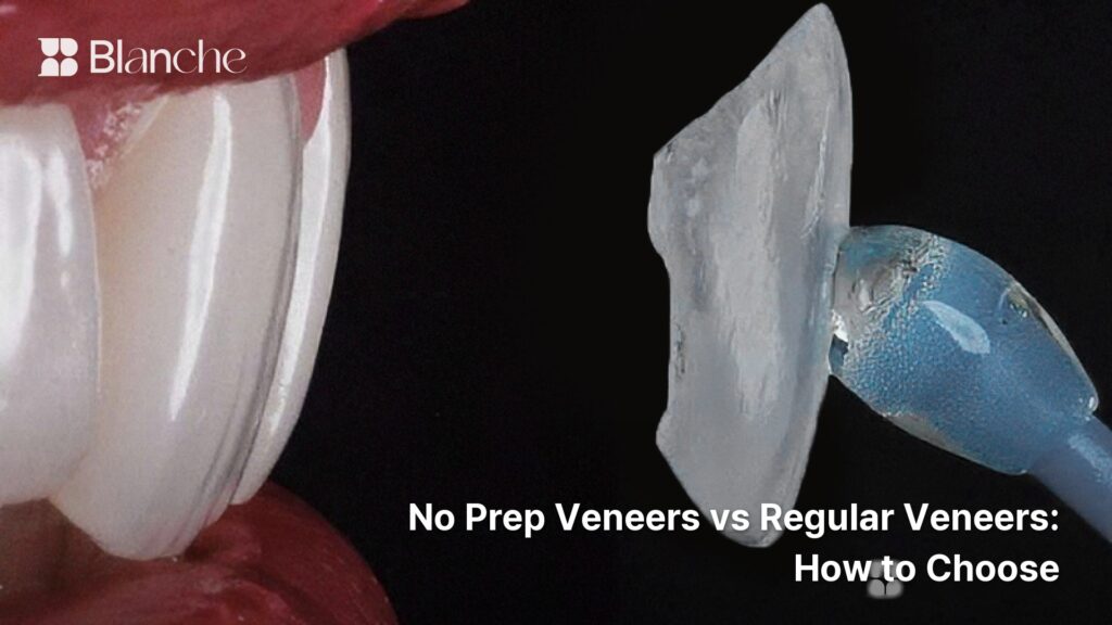 No Prep Veneers vs Regular Veneers How to Choose