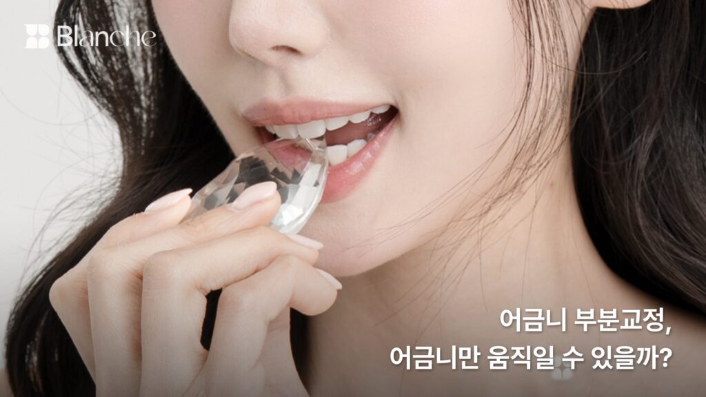 어금니 부분교정, 어금니만 움직일 수 있을까?