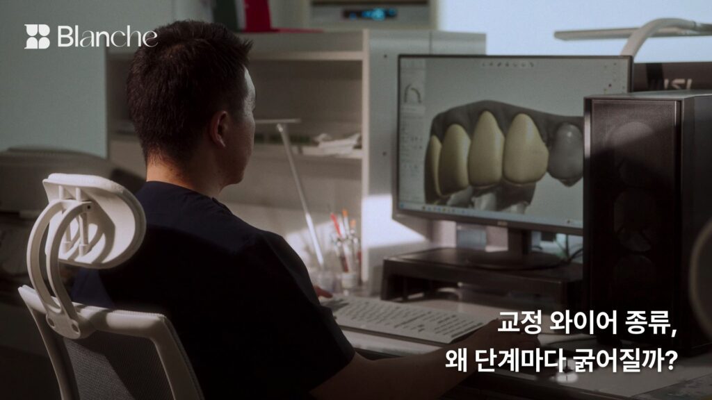 교정 와이어 종류, 왜 단계마다 굵어질까?