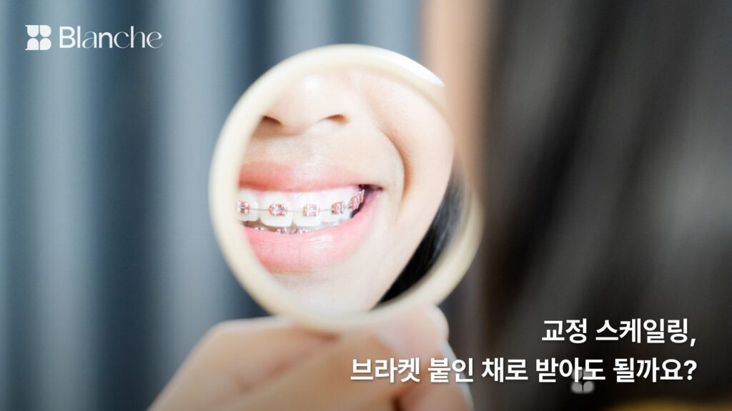 교정 스케일링, 브라켓 붙인 채로 받아도 될까요?