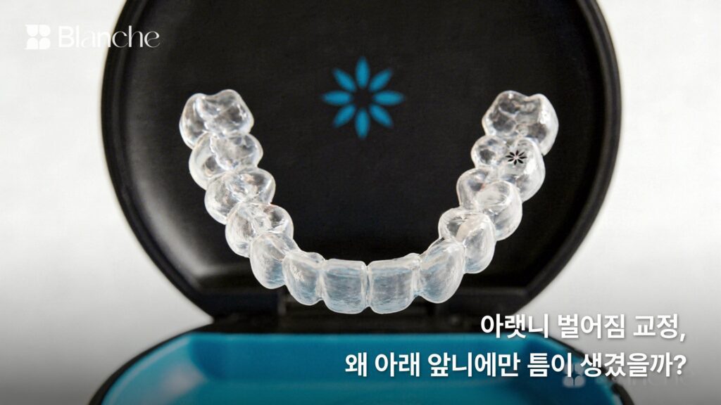 아랫니 벌어짐 교정, 왜 아래 앞니에만 틈이 생겼을까?
