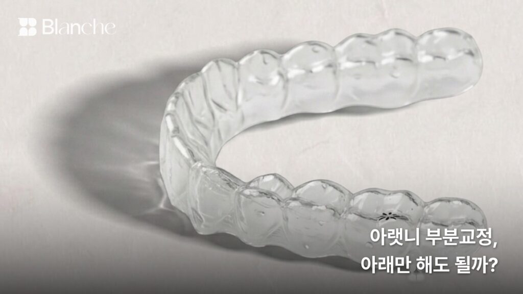 아랫니 부분교정, 아래만 해도 될까?