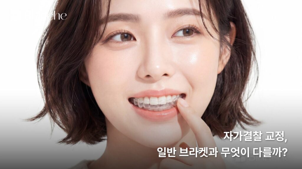 자가결찰 교정, 일반 브라켓과 무엇이 다를까?