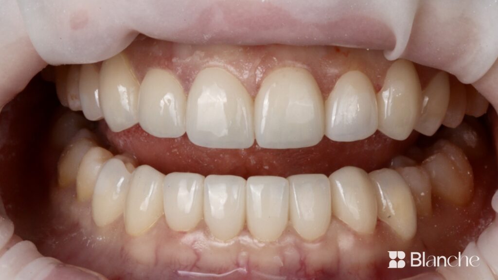 Blanche Dental Clinic treatment case