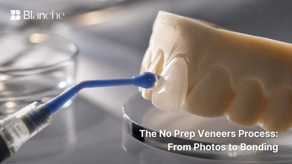 The No Prep Veneers Process: From Photos to Bonding