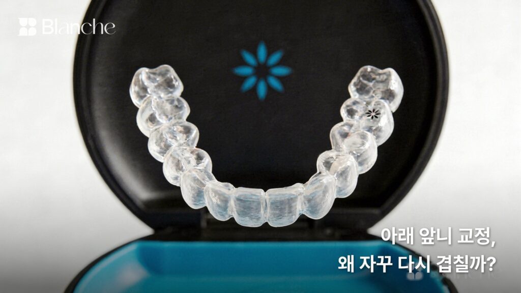 아래 앞니 교정, 왜 자꾸 다시 겹칠까?