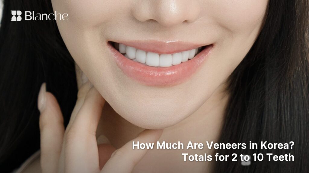 How Much Are Veneers in Korea? Totals for 2 to 10 Teeth
