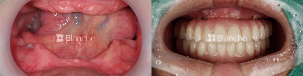 Actual dental implant case at Blanche Dental Clinic