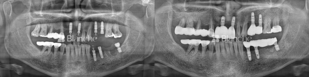 Actual dental implant case at Blanche Dental Clinic