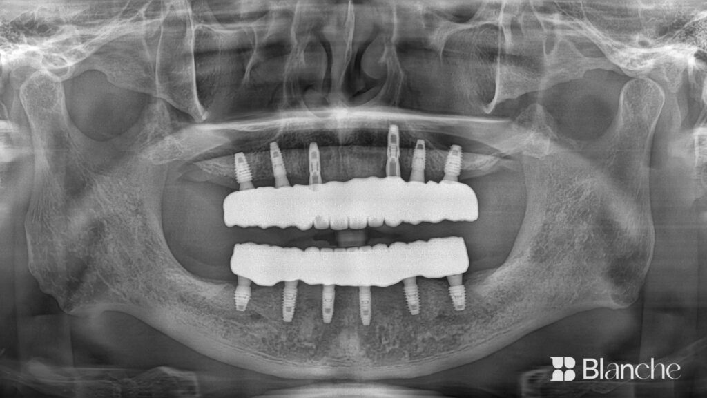 Actual dental implant case at Blanche Dental Clinic
