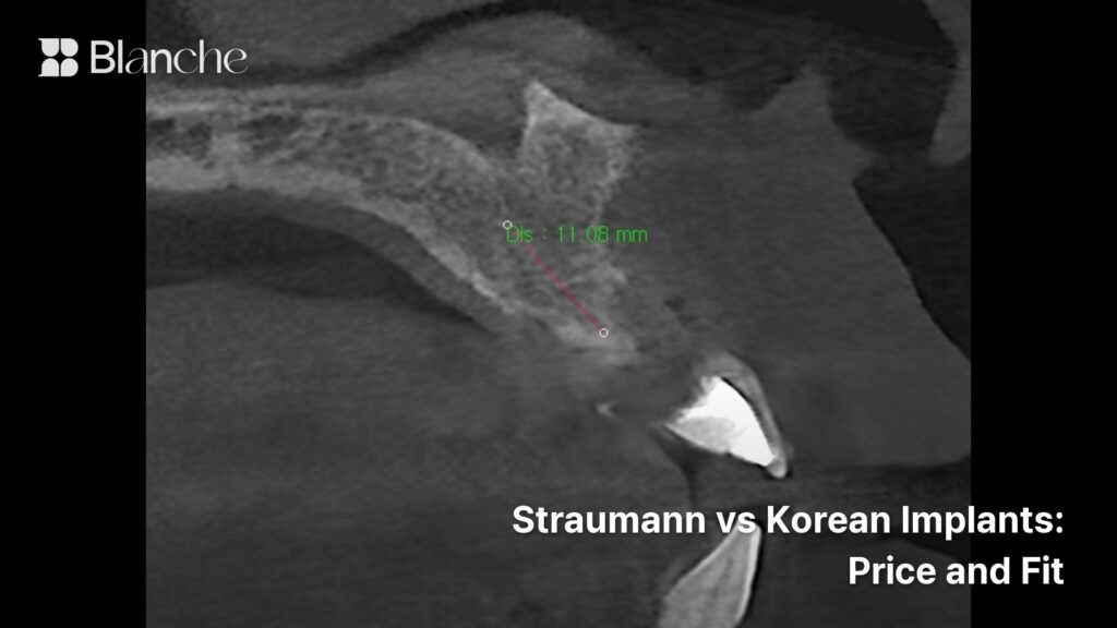 Straumann vs Korean Implants Price and Fit