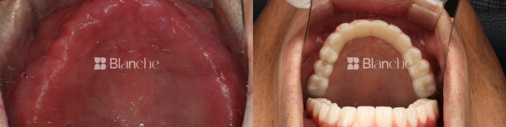 Actual dental implant case at Blanche Dental Clinic