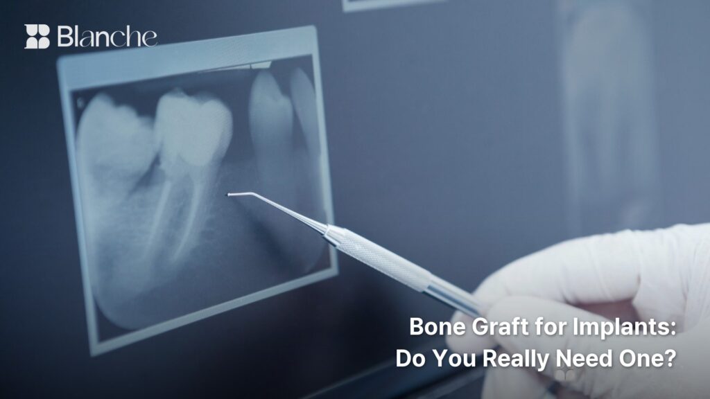 Bone Graft for Implants Do You Really Need One?
