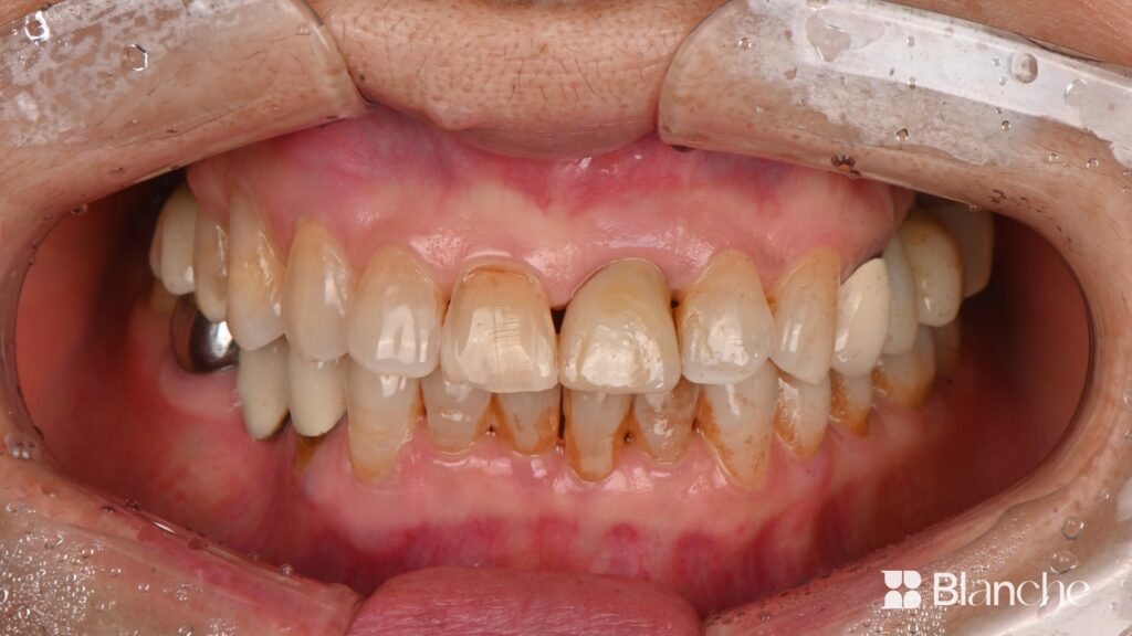 Actual dental implant case at Blanche Dental Clinic