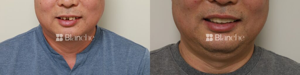 Actual dental implant case at Blanche Dental Clinic