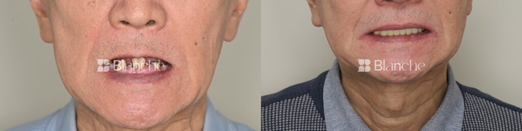 Actual dental implant case at Blanche Dental Clinic