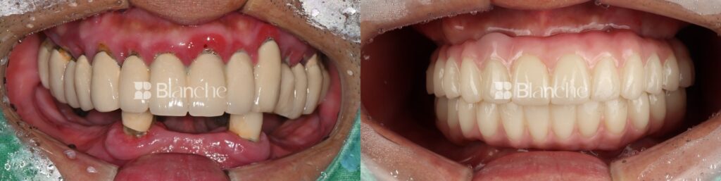 Actual dental implant case at Blanche Dental Clinic
