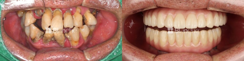 Actual dental implant case at Blanche Dental Clinic