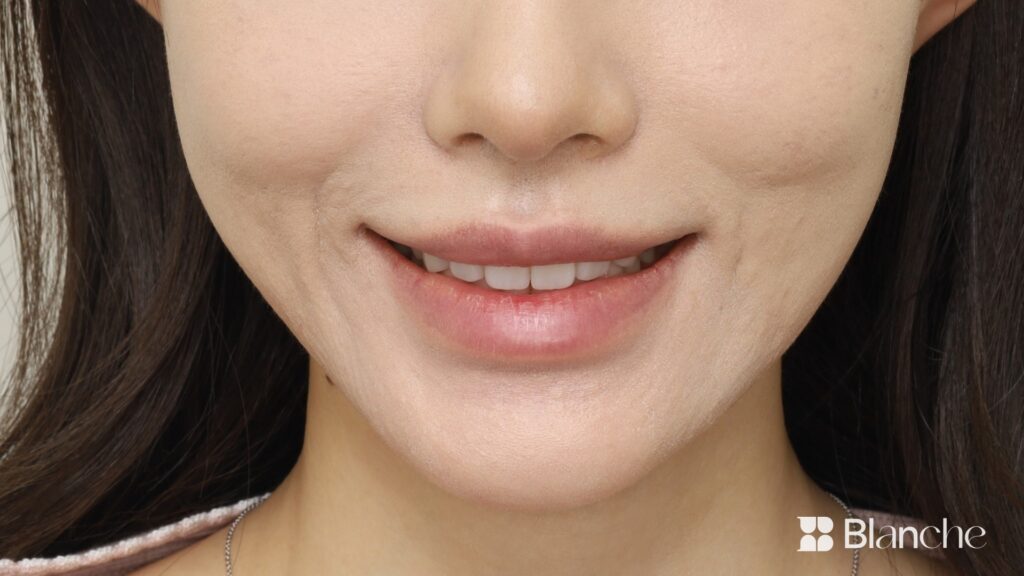 Actual veneer case at Blanche Dental Clinic