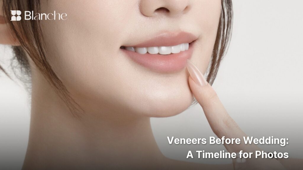 Veneers Before Wedding A Timeline for Photos