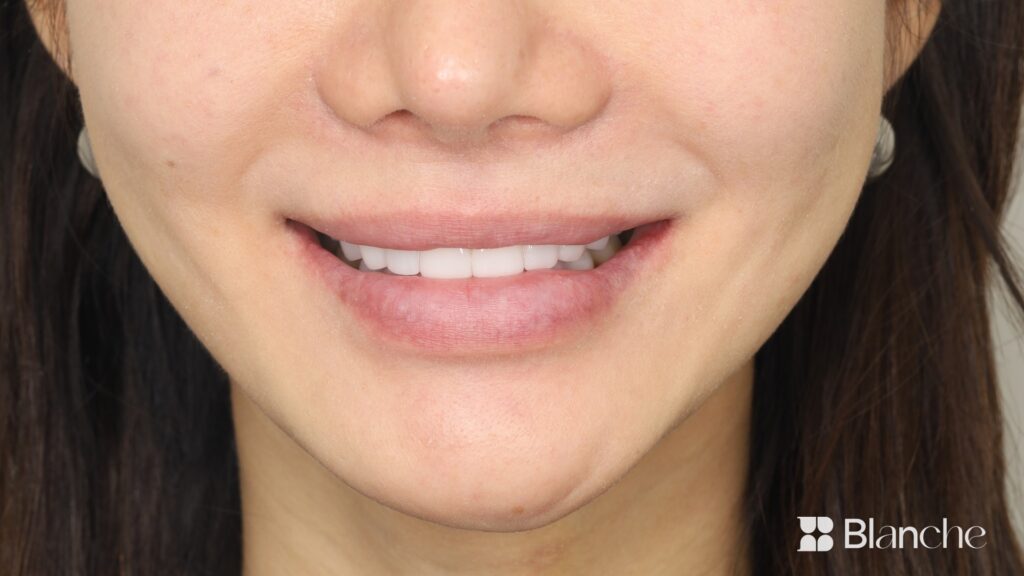Actual veneer case at Blanche Dental Clinic