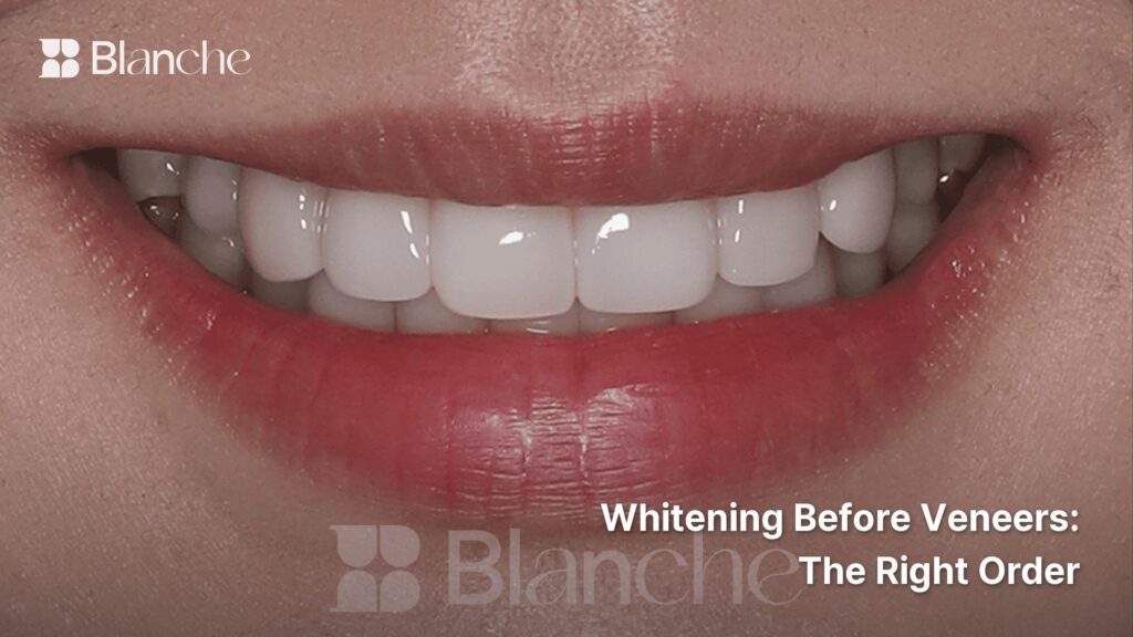 Whitening Before Veneers The Right Order