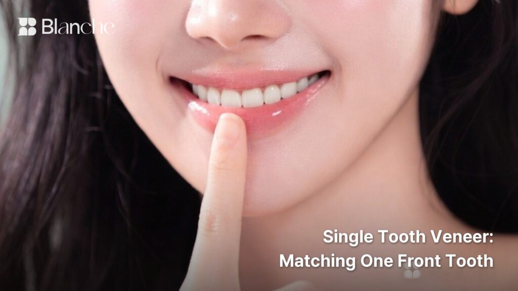 Single Tooth Veneer Matching One Front Tooth