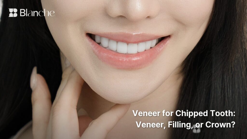 Veneer for Chipped Tooth Veneer, Filling, or Crown?