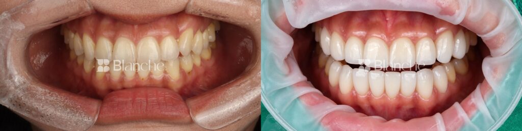 Actual veneer case at Blanche Dental Clinic