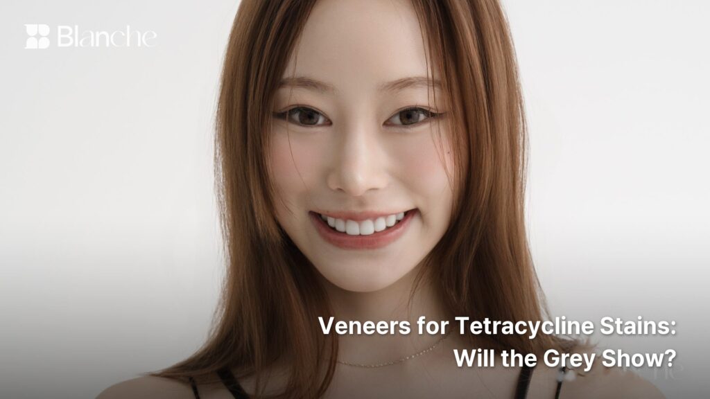 Veneers for Tetracycline Stains Will the Grey Show?