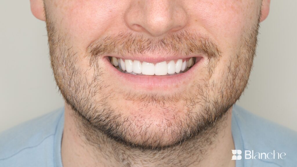 Actual veneer case at Blanche Dental Clinic