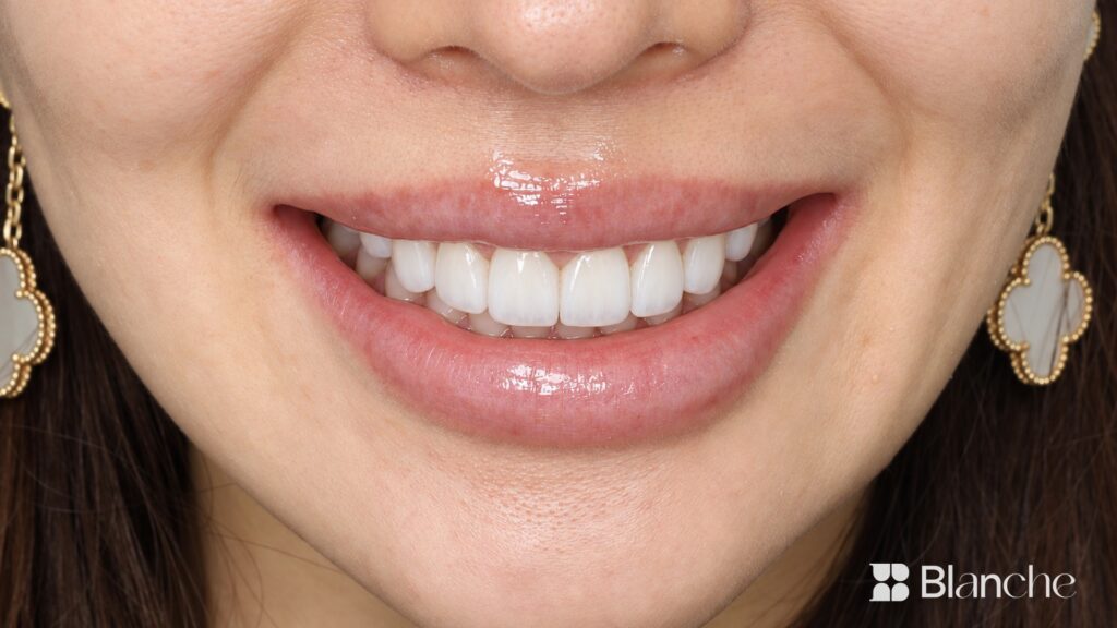 Actual veneer case at Blanche Dental Clinic