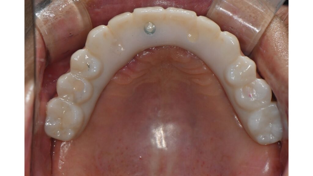 Upper full-arch implant restoration