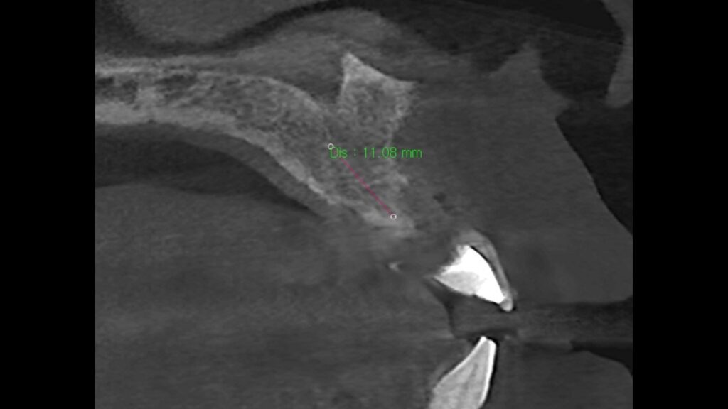 3D CT analysis of jawbone before implant surgery