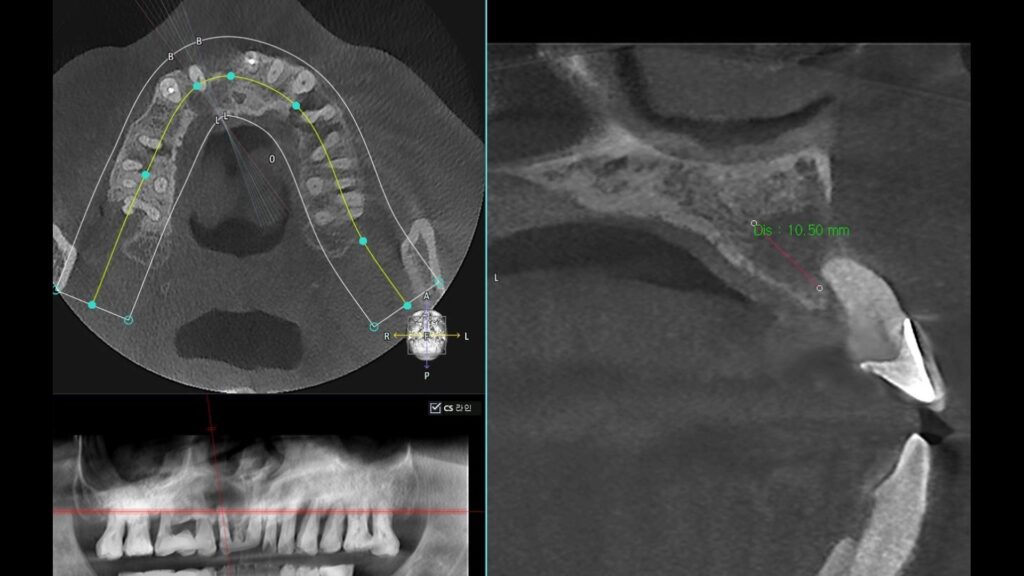 3D CT scan used to plan dental implants