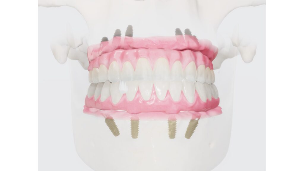 Illustration of a full-arch bridge on implants
