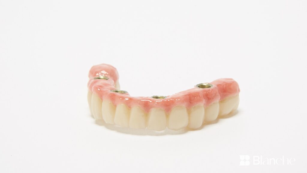 Full-arch implant bridge model