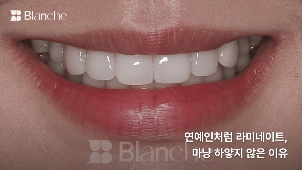 연예인처럼 라미네이트, 이왕 하신다면 이렇게 말씀하세요