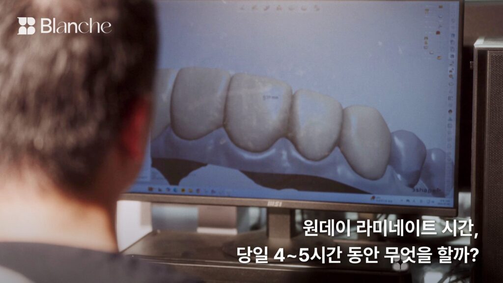 원데이 라미네이트 시간, 당일 4~5시간 동안 무엇을 할까